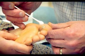 Cryotherapy For Plantar Warts | Adelaide Physio and Podiatry Clinic