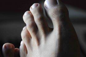 Hammer Toes | Adelaide Physio and Podiatry Clinic