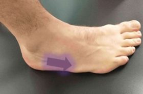 Iselin’s Disease | Adelaide Physio and Podiatry Clinic