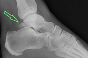 Os Trigonum Syndrome | Adelaide Physio and Podiatry Clinic