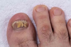 fungal nails | Adelaide Physio and Podiatry Clinic
