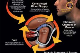 tmd-pain-cycle